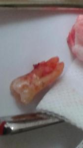 tooth extracted